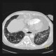 Sclerodermia, pulmonary fibrosis, UIP, fibrosis, oesophagus: CT - Computed tomography